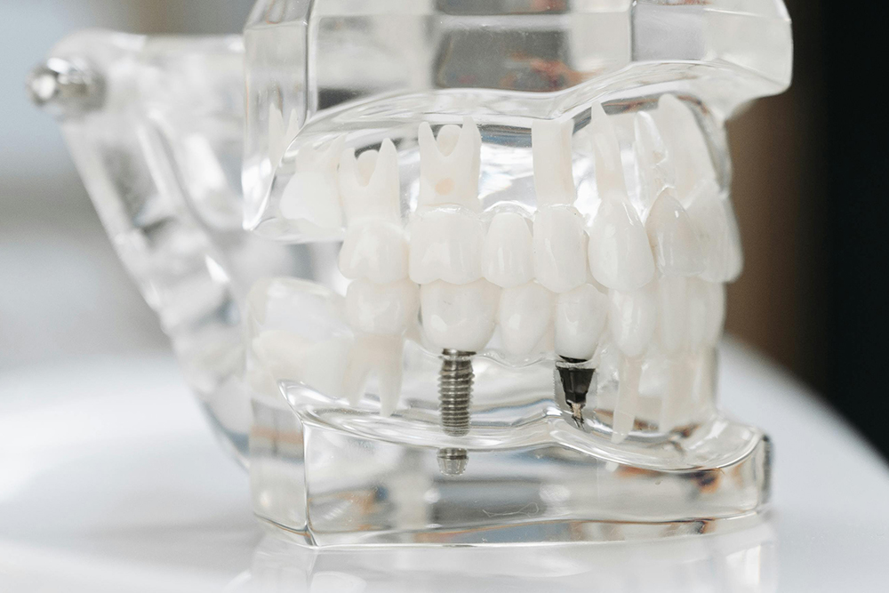 Dental implants at Erin Hills Dental in Erin restoring a natural-looking smile