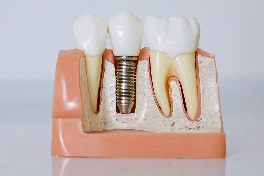 Root canals at Erin Hills Dental in Erin restoring a natural-looking smile