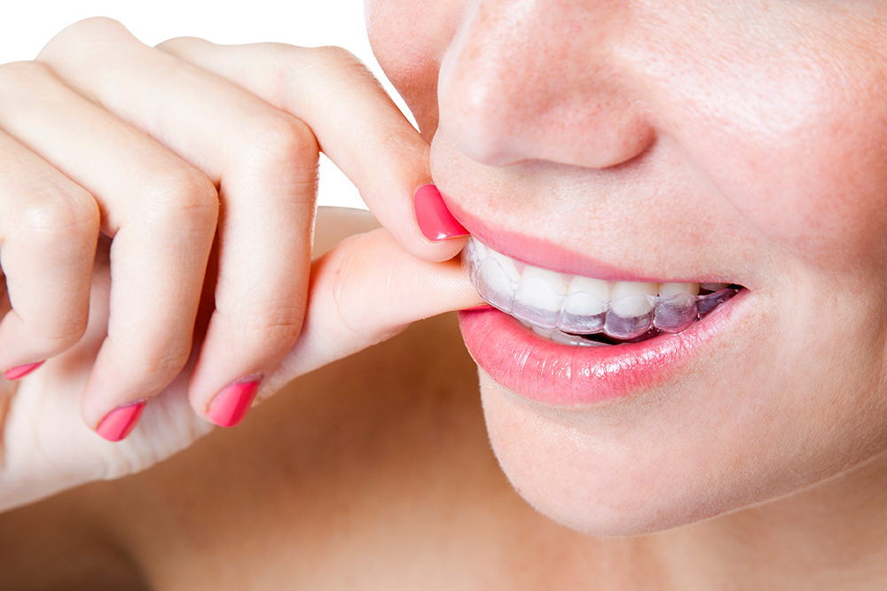 Clear aligners in a case during Invisalign treatment